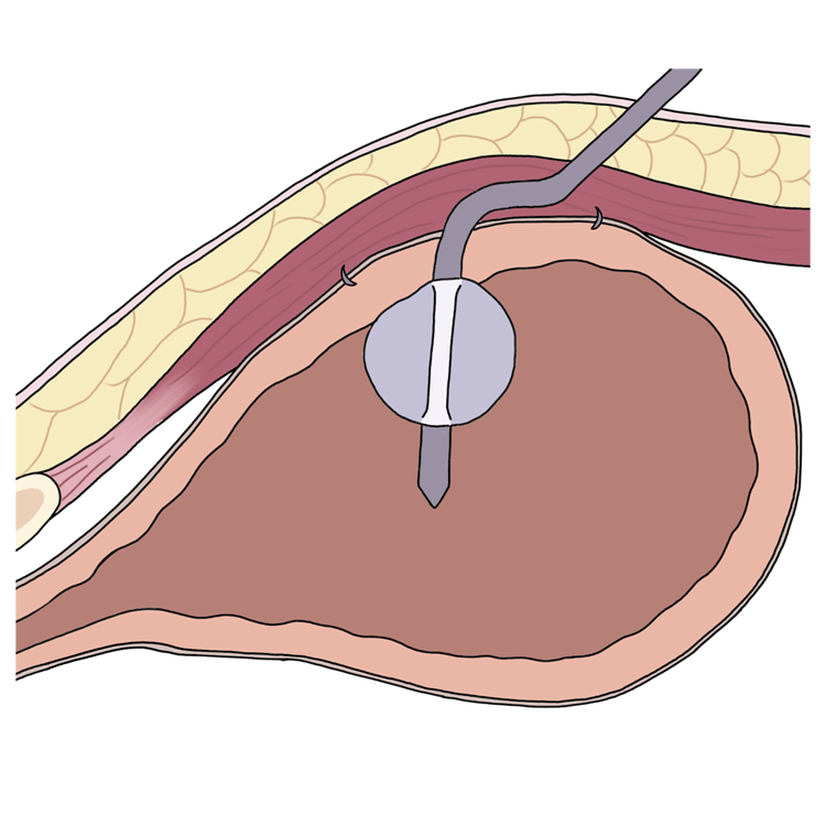 The tube is held in place within the bladder via an inflated balloon